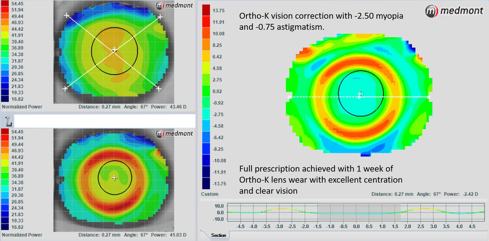 Corneal topography before and after one week of Ortho-K treatment for myopia and astigmatism